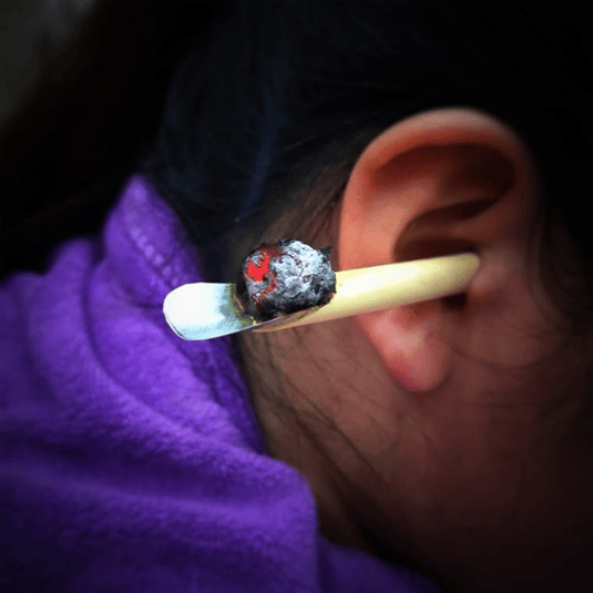tubule moxibustion tubule moxibustion
